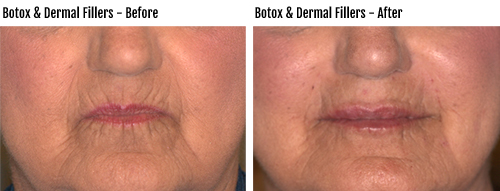 Botox and Dermal Fillers Before & After