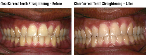 Nora Dental ClearCorrect Before and After